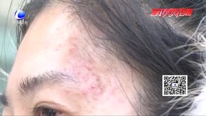 美容差點變毀容 愛美人士需謹(jǐn)慎